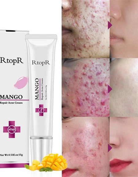Mango Repair Acne Cream