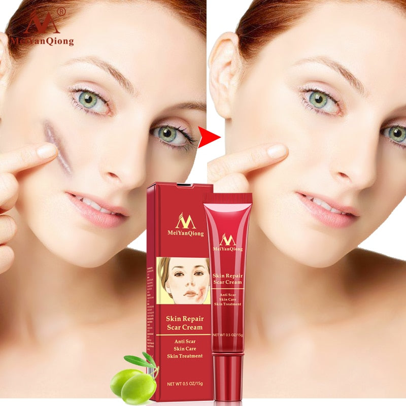 Acne Scar Stretch Mark