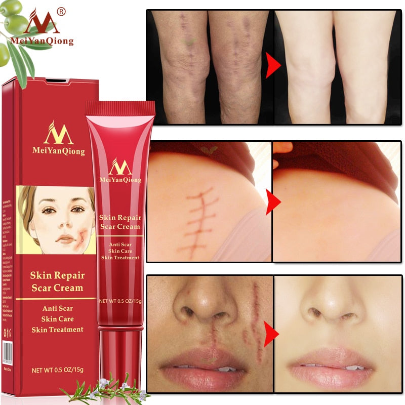 Acne Scar Stretch Mark