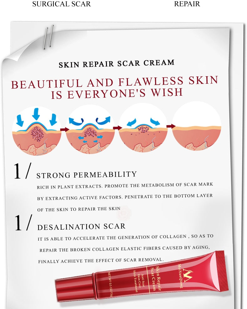 Acne Scar Stretch Mark